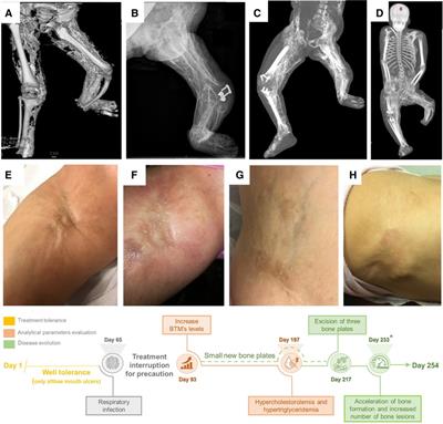 Case Report: Everolimus reduced bone turnover markers but showed no clinical benefit in a patient with severe progressive osseous heteroplasia